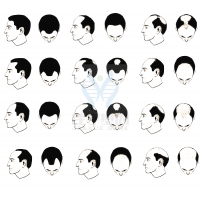 【佳學(xué)基因檢測(cè)】過(guò)早<font color='red'>脫發(fā)</font>、掉發(fā)太多怎么辦？你的方法可能是錯(cuò)的！