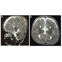 <b>【佳學(xué)基因檢測(cè)】唐奈-巴羅綜合征基因檢測(cè)（DBS)及其治療</b>