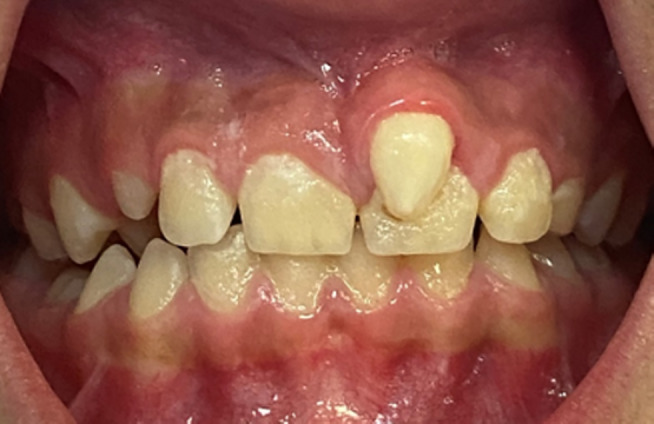 牙齒基因異?；驒z測