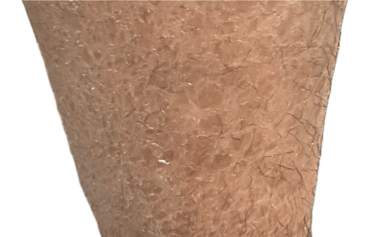 圖1：圖1. 下肢出現(xiàn)多邊形、暗色、鱗狀斑塊伴增厚斑塊。